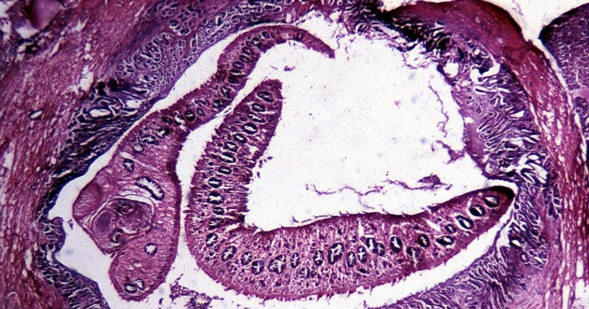 Motylica wątrobowa - przyczyny i objawy choroby