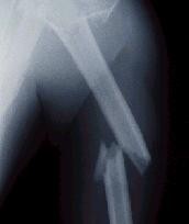 brokenarm-d000000132d6552ab74ae