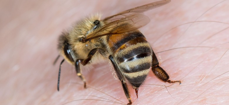 Uczulenie na osy, pszczoły, szerszenie? OBJAWY, które trzeba znać