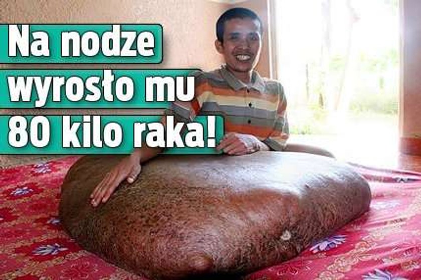 Na nodze wyrosło mu 80 kilo raka!