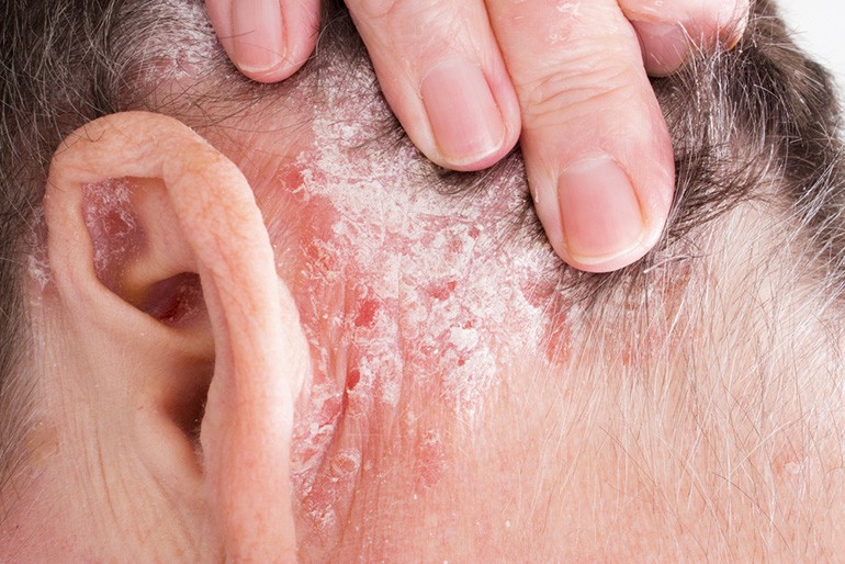 Pikkelysömör (pszoriázis, psoriasis) tünetei és kezelése