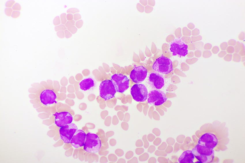 U normalnim okolnostima, samo 5 odsto svih krvnih ćelija u koštanoj srži treba da budu blasti, a ne bi trebalo da se imaju ni u krvi