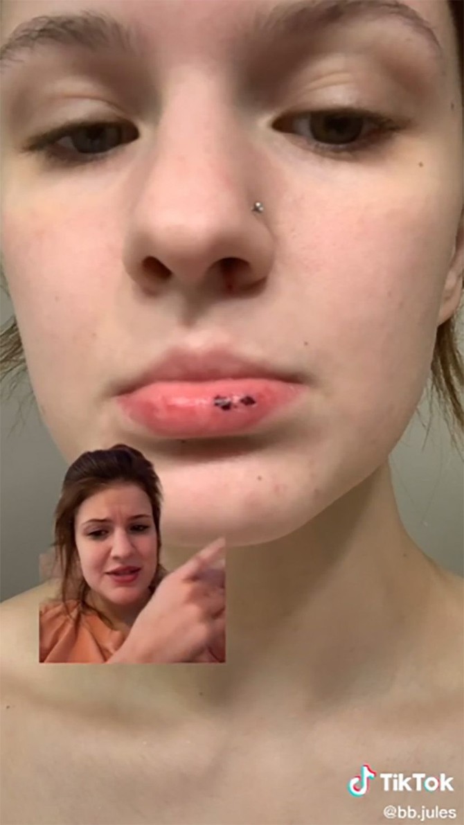 Julijani se pojavio osip koji je ukazao na užasnu bolest, Foto: tikTok
