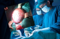 Lekarze usunęli guz jajnika wielkości wiadra. "To jeden z najgorszych nowotworów"