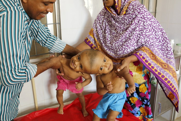 DZIEWCZYNKI ZŁĄCZONE GŁÓWKAMI. ZDOŁAJĄ JE ROZDZIELIĆ?