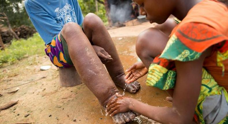 Health Ministry says 122m Nigerians at risk of contracting Neglected Tropical Diseases. [sabin]