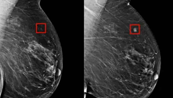 Obraz po lewej stronie pokazuje coś, co sztuczna inteligencja zidentyfikowała jako raka, po prawej stronie obraz wykonany cztery lata później, gdy nowotwór zaczął się on rozwijać Fot. Lauder Breast Center at the Memorial Sloan Kettering Cancer Center
