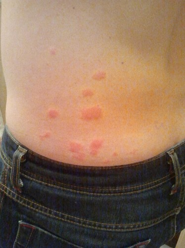 Pasażer pogryziony przez pluskwy w PKP