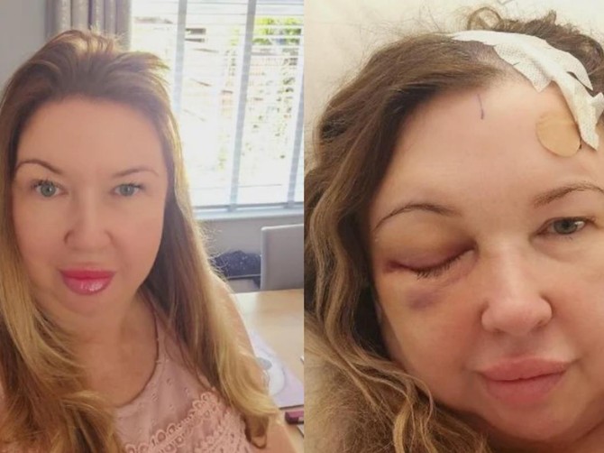 Otišla kod optičara po naočare, saznala da ima tumor na mozgu, a onda dobila i dijagnozu raka dojke