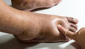 Leg swelling is also known as edema [Shutterstock]