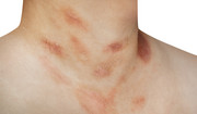 Łupież Gilberta - choroba skóry, która objawia się wysypką i czerwonymi znamionami na ciele