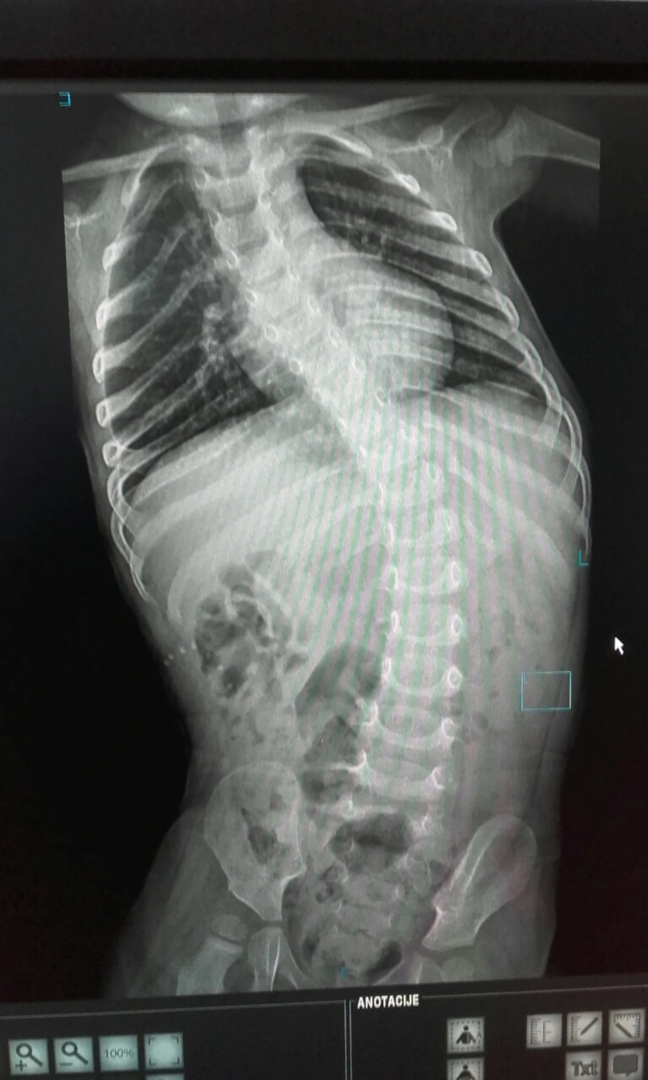 Zbog slabih mišića iskrivila se kičma pa je operacija jedino rešenje