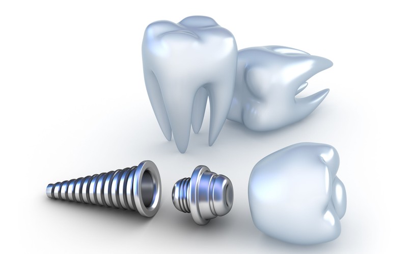 Implanty to jedno z najnowocześniejszych rozwiązań