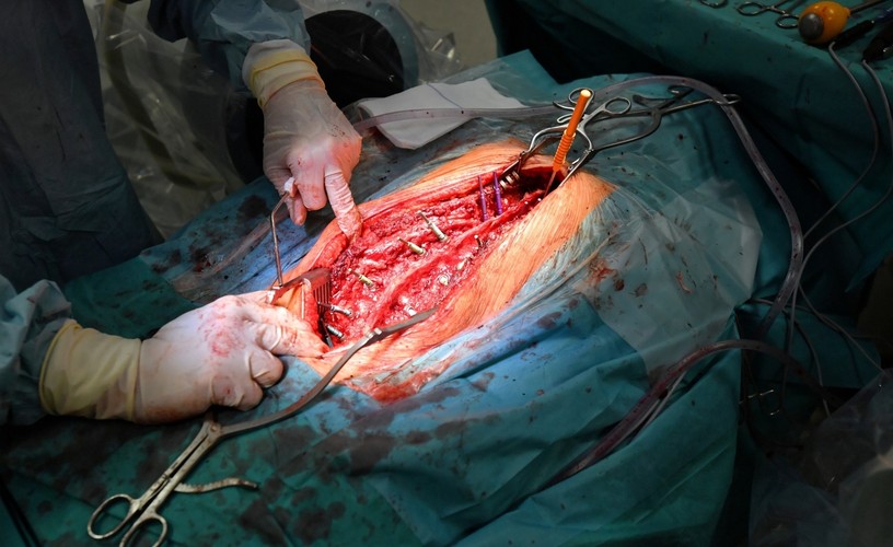 SKOMPLIKOWANA OPERACJA KRĘGOSŁUPA W SZCZECINIE