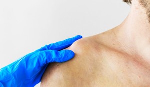 Najčešći uzroci bola u ključnoj kosti su povrede i artritis
