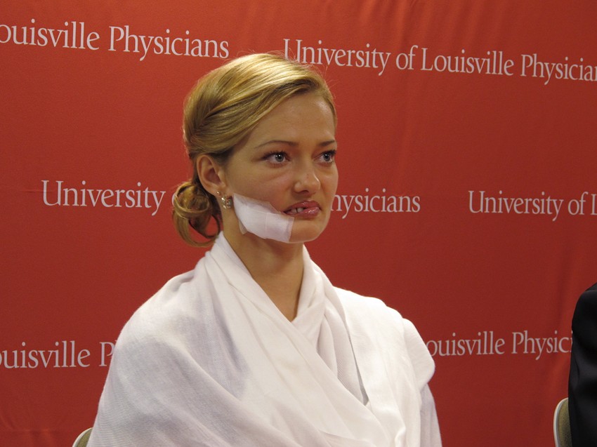 Lesja Kotevske nakon prve u nizu operacija, sa povezom na licu koji pokriva uništeni obraz