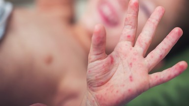 Pruszków: Ognisko epidemiczne odry w jednej ze szkół. 10 potwierdzonych zachorowań