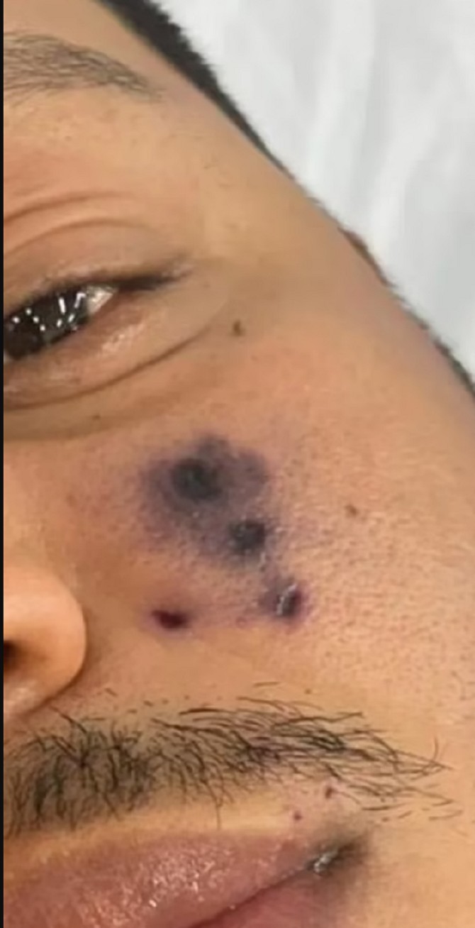 Brazilski pevač Darlin Morais umro nakon što ga je pauk ujeo za lice