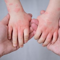 IgG alapú ételallergia teszt: kiderült, fals eredményt is adhat