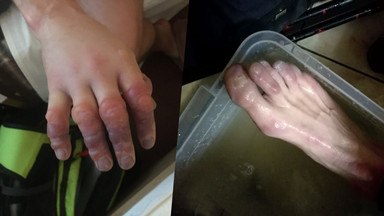 Akcje GOPR w weekend. Ratownicy pokazali wstrząsające zdjęcia odmrożonych dłoni i stóp