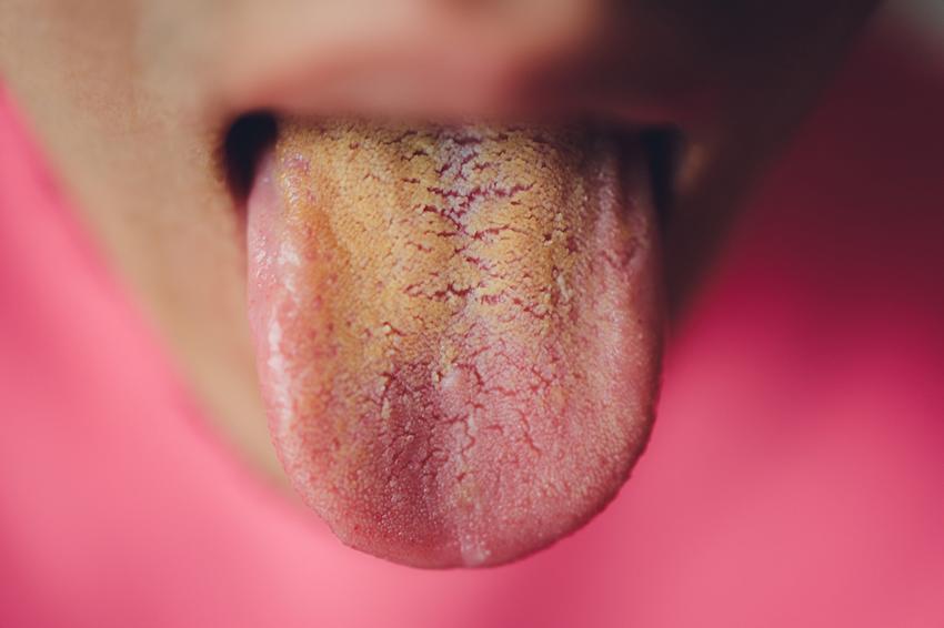 It can be severely caused by food or drink coloring and smoking.  Yellow discoloration and firm plaques can be due to a fungal infection (in which case they can be erased), but it can also indicate a problem with the bile ducts or liver.