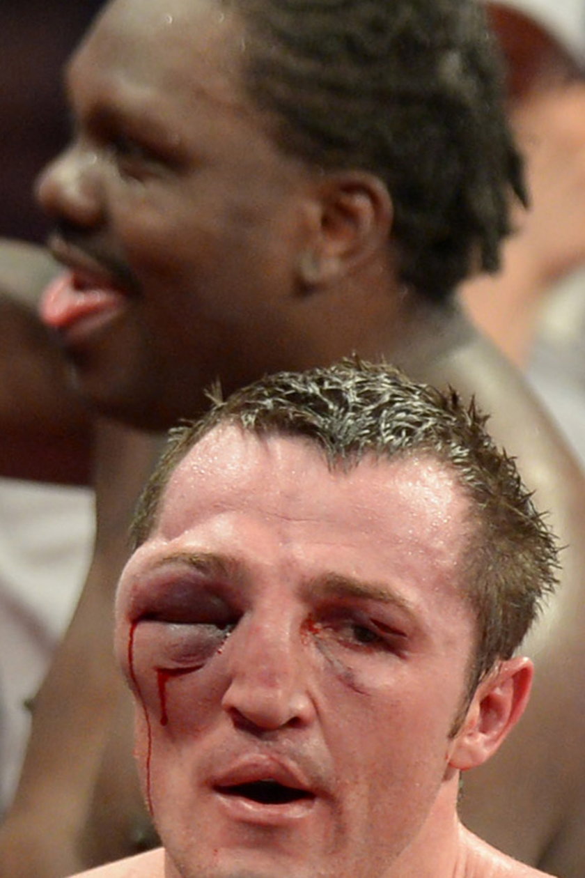 Zmasakrowane twarze bokserów