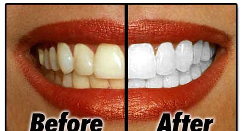 Teeth Whitening