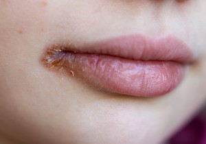 Žvale su ograničene na uglove usta i ne proizvode plikove 