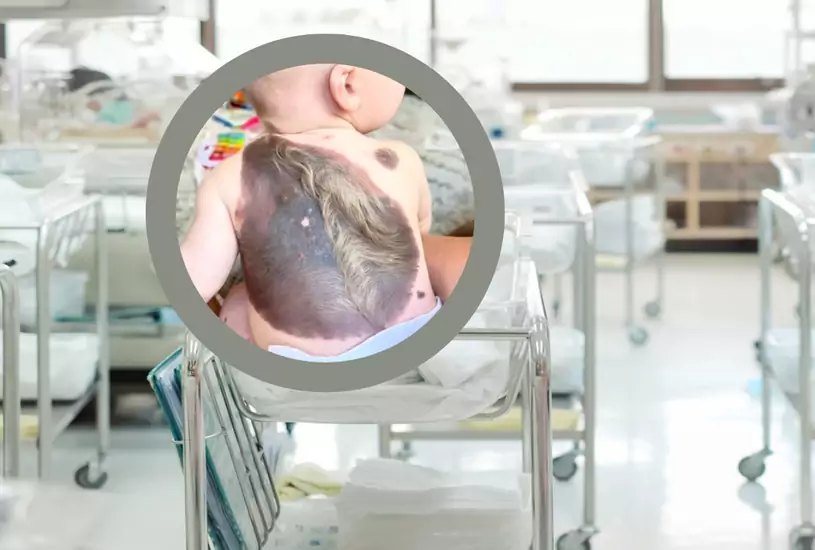 Chłopiec urodził się z nietypową zmianą na skórze. Taki przypadek zdarza się raz na 500 tys.