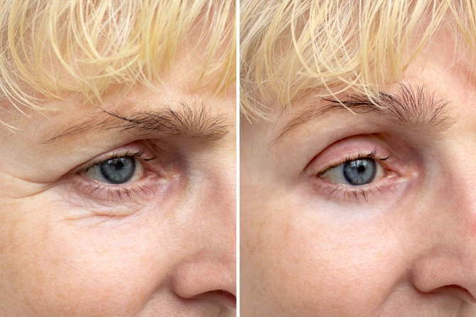 Blefaroplastika