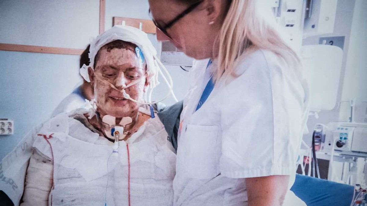 Ema je iz stravičnog požara spasila šestoro dece, evo kako izgleda posle 20 operacija