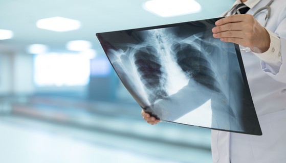 Tüdőgyulladás - még ma is igen veszélyes az influenza gyakori szövődménye