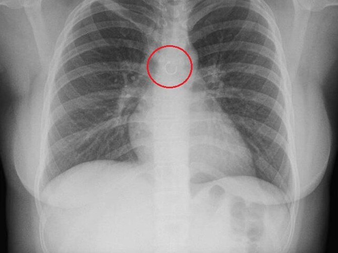 Imala je hroničan kašalj, a kad su lekari uradili snimak pluća zamalo nisu pali sa stolice