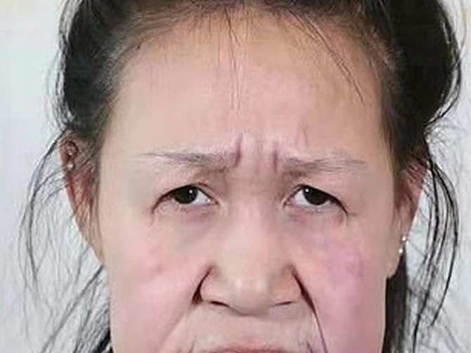 Ksio Fang pre operacije
