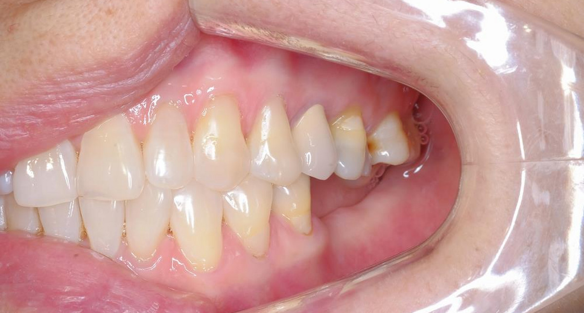 Co powoduje przebarwienia zębów?