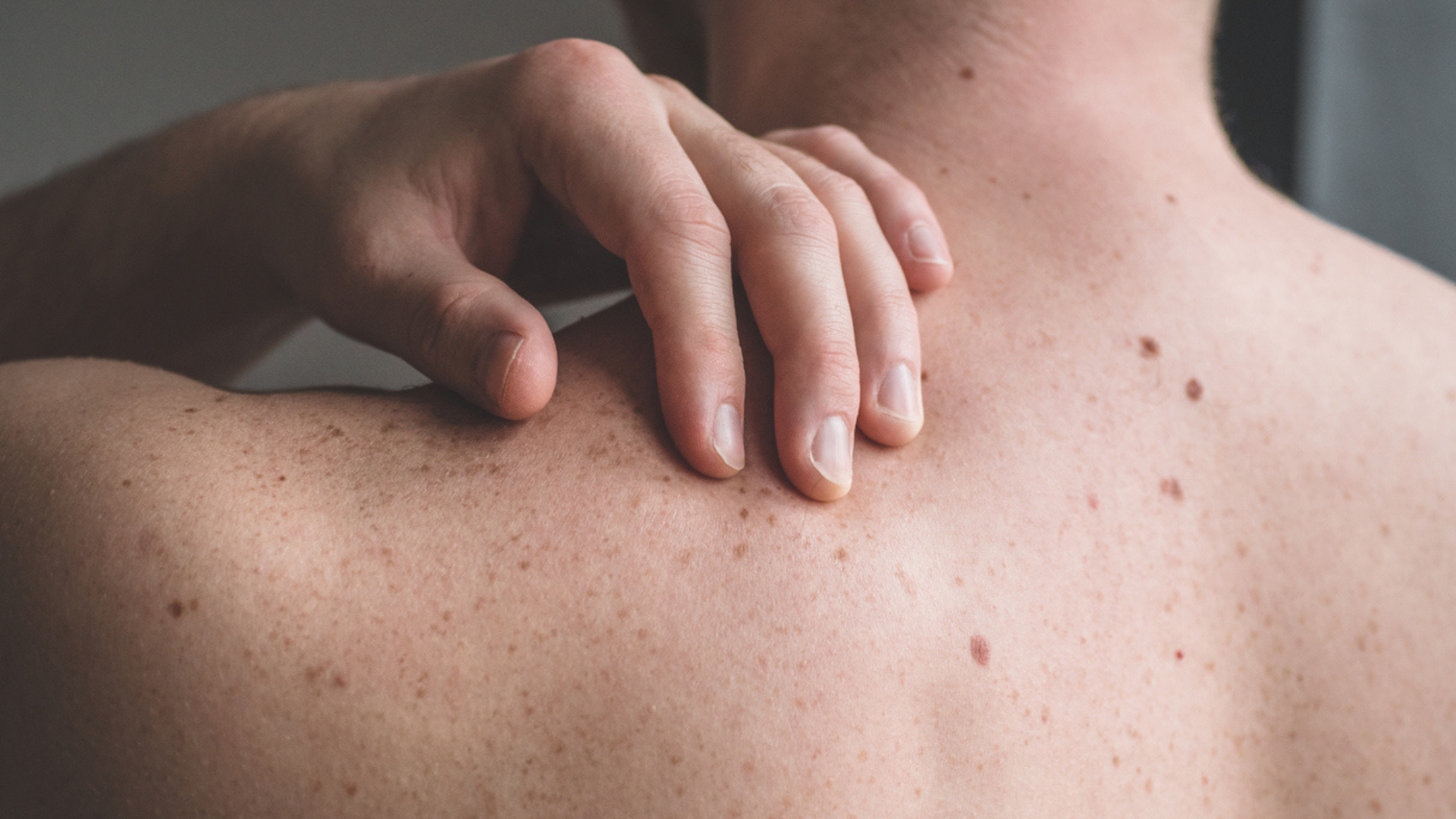 Znamienka v chronicky dráždených oblastiach odporúča dermatologička odstrániť. (ilustračné foto)