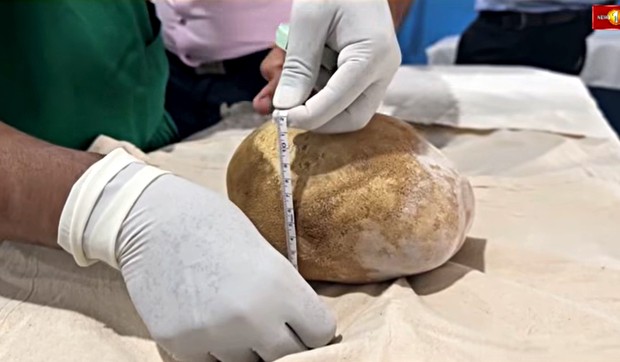 Lekari uspešno su uklonili kamen iz bešike težak 3,1 kg, što je najteži poznati slučaj u medicinskoj istoriji