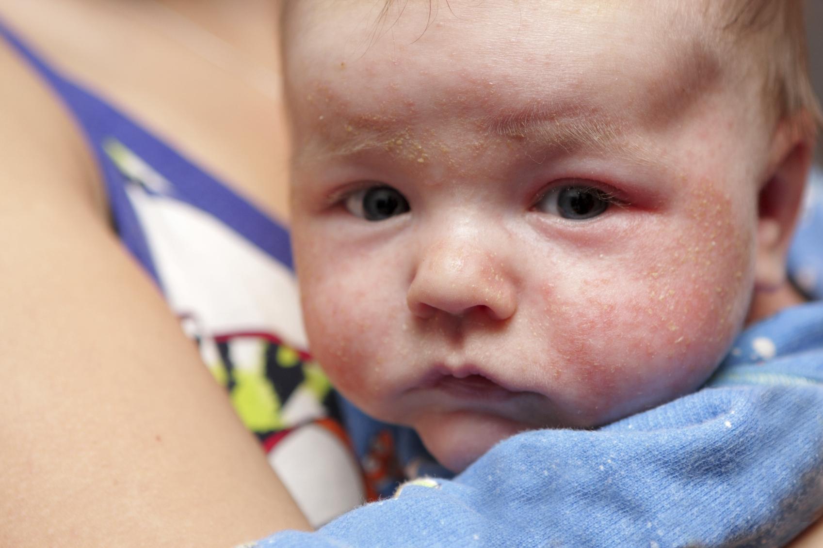 Ako zistiť, či má dieťa naozaj alergiu? A čo znamená, keď má ekzém? |  Najmama.sk