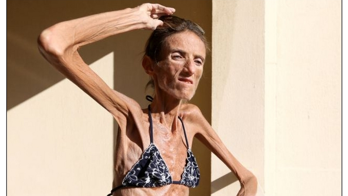 Ta historia zaszokowała cały świat. 39-letnia Valeria Levitin na skutek drastycznej diety, stosowanej przez wiele lat, przy wzroście 1,72 metra, waży zaledwie 26 kilogramów. Teraz opowiada, jak choroba zrujnowała jej życie.