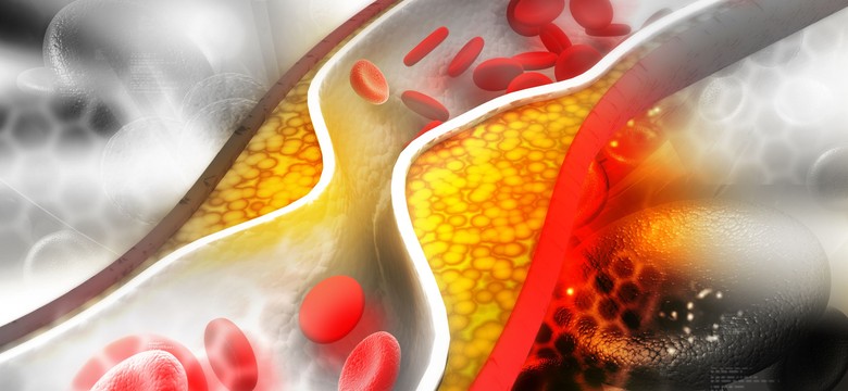 Dobry i zły cholesterol. Co wiesz na ten temat?