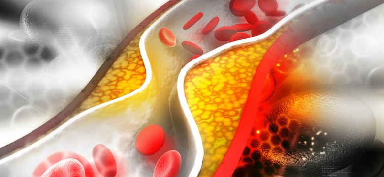 Co drugi Polak ma zbyt wysoki poziom cholesterolu, a leczy się niewielu