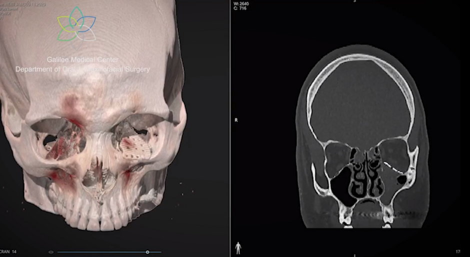 Skanowanie uszkodzonej czaszki za pomocą tomografu komputerowego /JPost.com