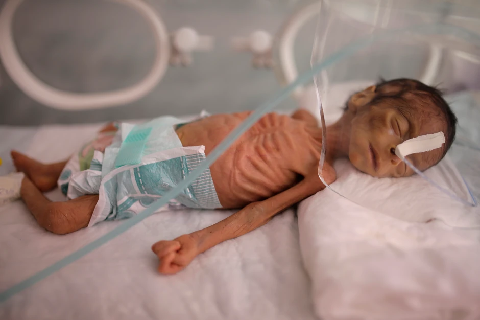 Broj akutno neuhranjene dece mogao bi da početkom naredne godine dostigne 1,2 miliona