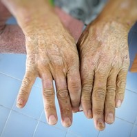 Kemény, érdes bőr: nem szimpla bőrbetegség, ha scleroderma okozza