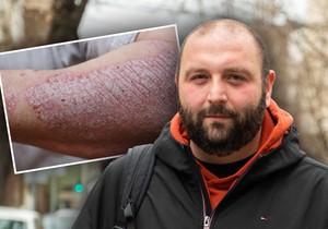 Zahvaljujući najsavremenim terapijama moguće osloboditi se od simptoma psorijaze, imati čistu kožu i voditi kvalitetniji život, kaže Vladimir Kecić