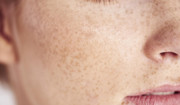 Zaburzenia barwnikowe skóry - jakie są ich rodzaje? Jak rozpoznać i leczyć?