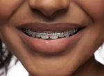 5 signs you may need to get braces