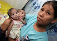 PHILIPPINES CONJOINED TWINS
