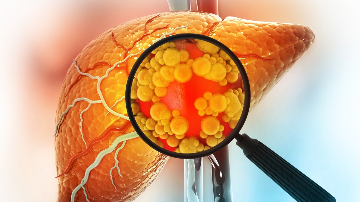 Metabolička bolest jetre je često povezana sa viškom kilograma 