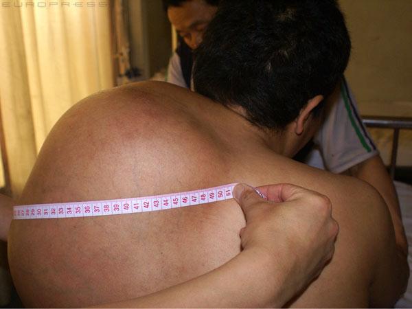 Tizenöt kilós tumort cipel a hátán - Blikk Rúzs